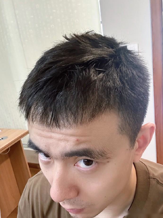 上针灸，赵继伟工作室：赵继伟嗓子治疗进入下一阶段