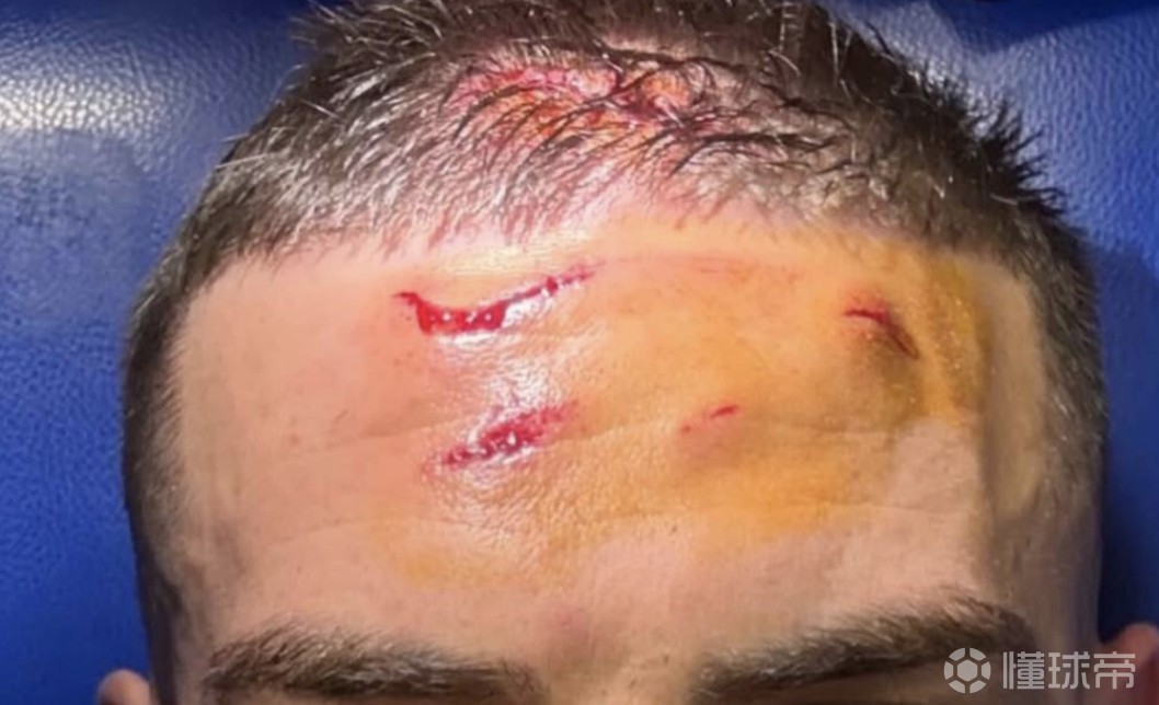 造点建功，被本塞拜尼踢伤的克尔斯托维奇在社媒晒出伤口照片