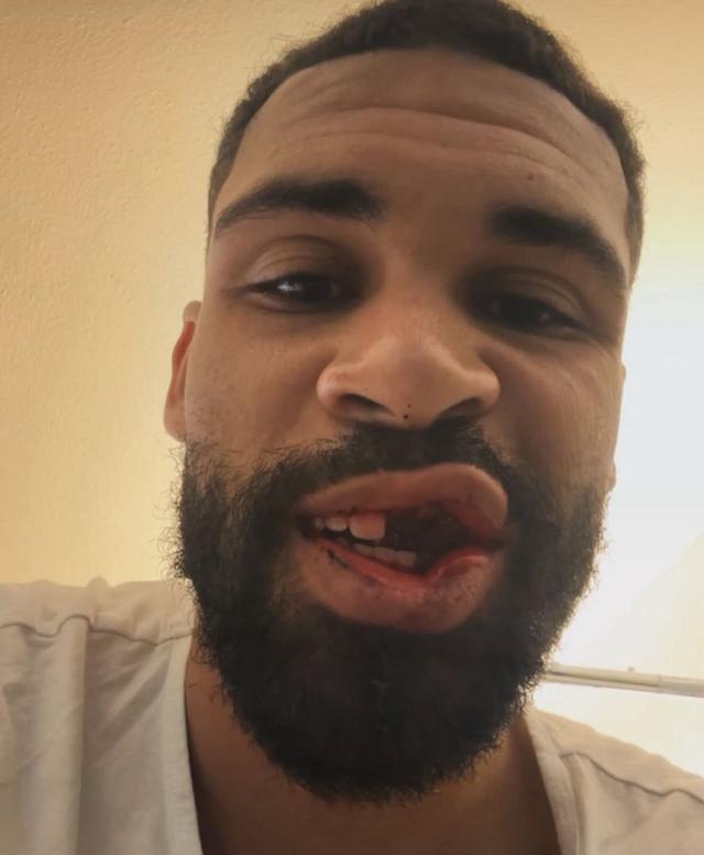 太惨了！米兰大将遭爆头门牙齐飞，下巴骨折恐无缘世界杯