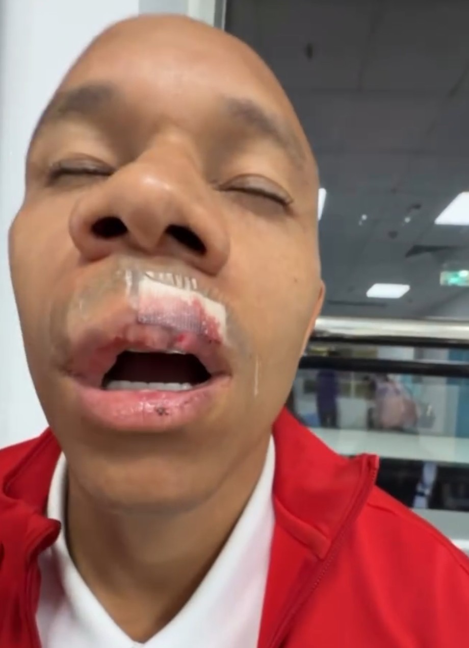 成都官方：席尔瓦第11、21牙半脱位，上颌前牙区牙槽骨骨折