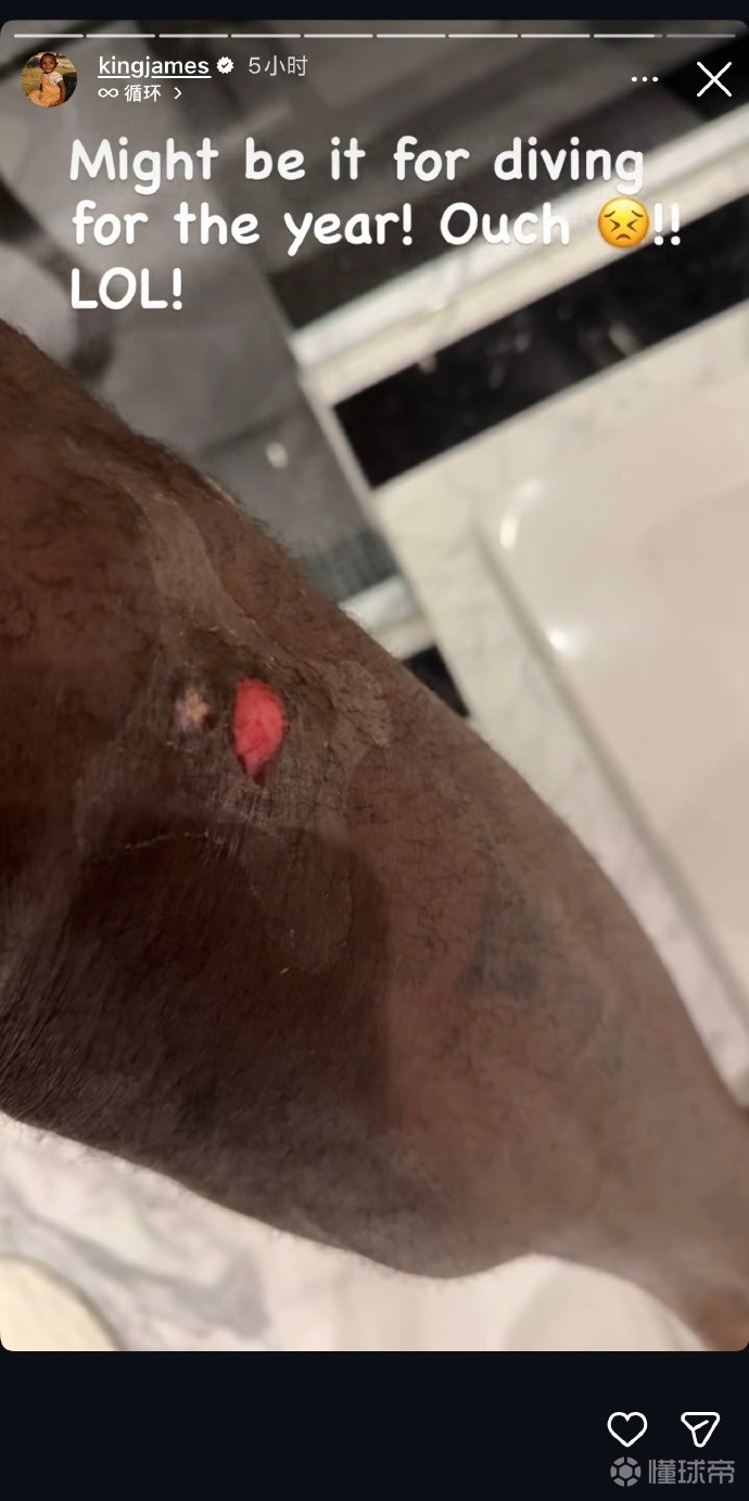 詹姆斯晒伤口照片：那或许是年度最佳倒地救球！疼死了！