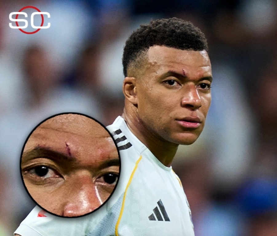 血染赛场！ESPN晒姆巴佩伤口图 眉毛上方明显伤痕