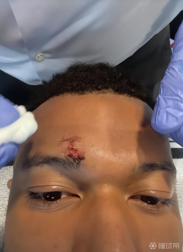 眉骨缝三针，姆巴佩社媒发布面部受伤部位特写