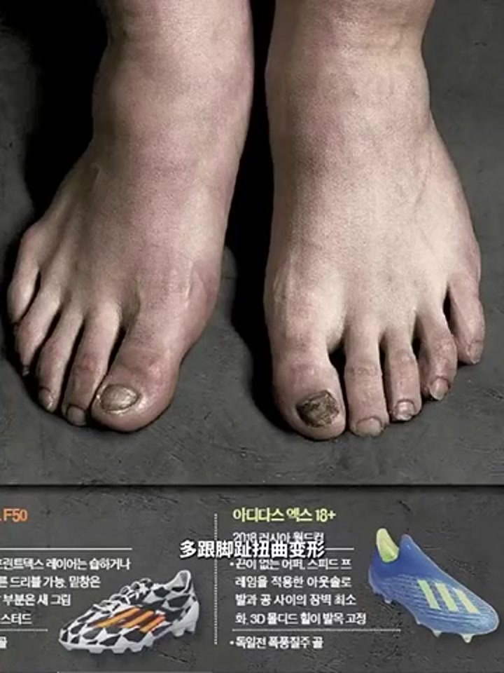 韩媒晒孙兴慜脚部照片 双脚已严重变形
